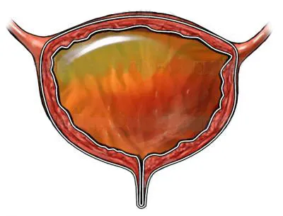 Възниква Задържане на урина защо и как да се прояви това състояние