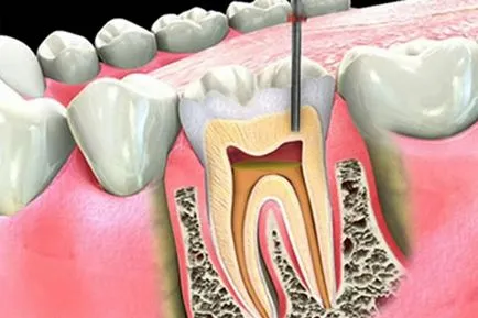 Deoarece dintele fiind canale tratate - dentare clinica perla Inskaya