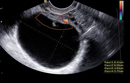 Как са яйчника на ултразвук