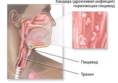 Candida езофагит, причини, симптоми, лечение