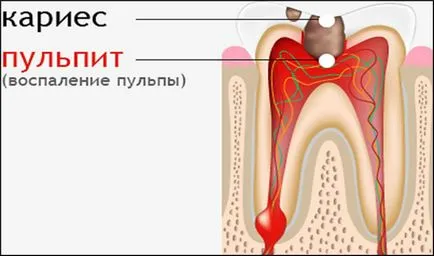 Cariile și diferențele și asemănările pulpita