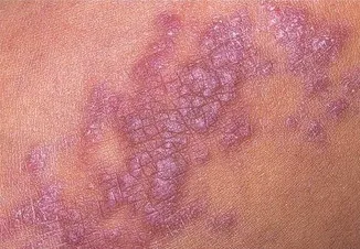 Lichen planus - cauze, simptome și tratament