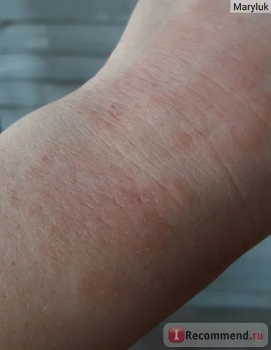 Krém külső használatra Jelfa momederm - „dermatitis megakadályozza nekem normális életet élni! de