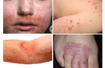 Krém és kenőcs gyermekeknek dermatitis hogyan válassza ki és alkalmazza