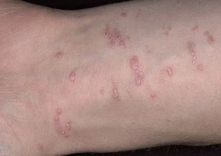 Lichen planus - cauze, simptome și tratament