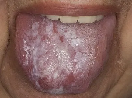 Lichen planus - cauze, simptome și tratament