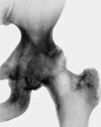 Tratamentul osteoartritei articulației șoldului - stadiul bolii, medicamente și proceduri