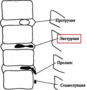 междупрешленните дискове лечение екструзия, терапии и хирургия