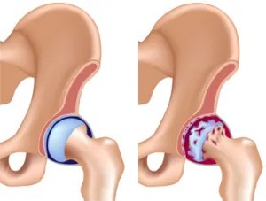 Tratamentul osteoartritei articulației șoldului - stadiul bolii, medicamente și proceduri