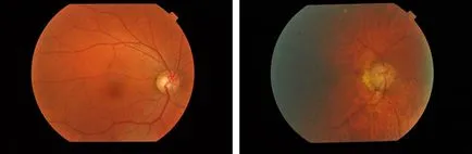 Lézeres glaukóma, Budapest, műtét szem glaukómás