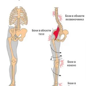 Tratamentul tipurilor flatfoot, simptome, diagnostic, tratament