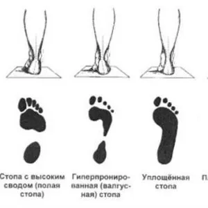 Tratamentul tipurilor flatfoot, simptome, diagnostic, tratament