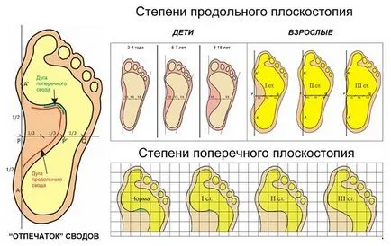 Лечение на плоско стъпало видове, симптоми, диагностика, лечение