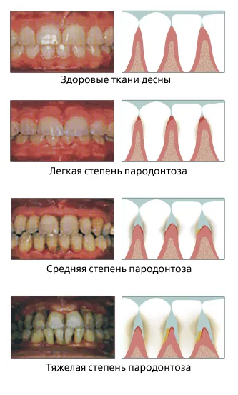 Мехлем от пародонтоза, гел и спрей за дъвки - по-добре е да изберете