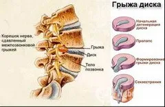 A kezelési módszerek a spinális sérv