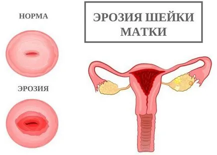 Poate endometrioza se dezvolta in cancer este transmis