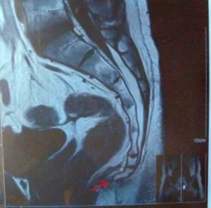 Опашната кост MRI лумбосакралната който показва опашната гръбнака изображения