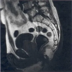 Опашната кост MRI лумбосакралната който показва опашната гръбнака изображения