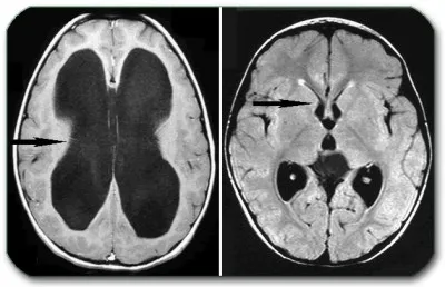 Külső hydrocephalus felnőtteknél a klinikai kép