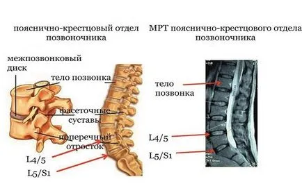 MRI лумбосакралната гръбнака и опашната кост