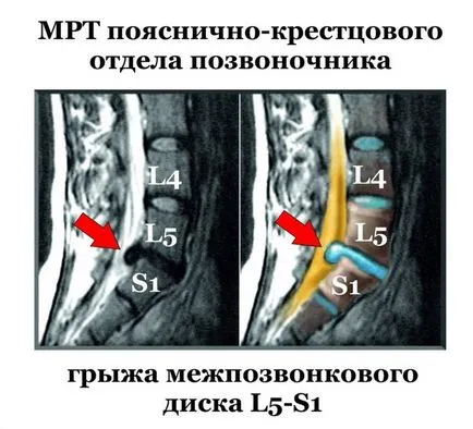 MRI лумбосакралната гръбнака и опашната кост