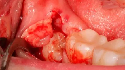 Unerupted bölcsességfog eltávolítás és kezelés, fogászati ​​kezelés