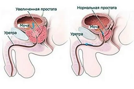 Нови методи за лечение на ДПХ и простатит при мъжете, които избират