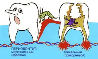 Характеристики на хода на пародонтит при деца