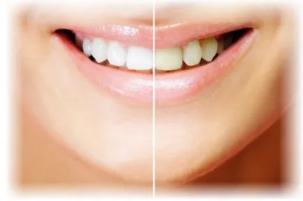 Избелване на зъбите - новост от отвъдното