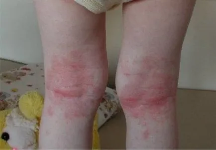 Tengerparti üdülés egy gyermek szenved atópiás dermatitisz, meg kell vizsgálni