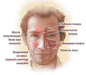 Parosmiya és cacosmia