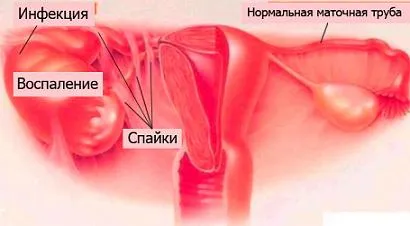 Piócák kezelésére női betegségek