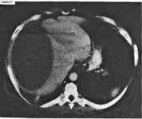 Subfrenic abces - cauze, simptome, diagnostic și tratament