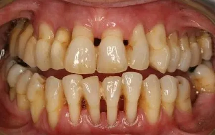 Öblítsük periodontitis gyógyszerek, gyógynövények, a betegségek megelőzése