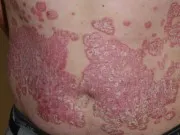 psoriasis kórház