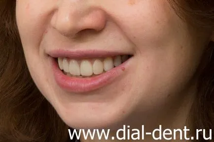 Протеза на предните горните зъби