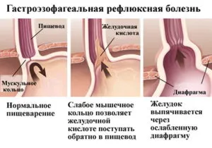 Reflux oesophagitis tünetek és a kezelés