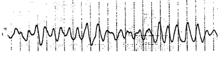 Arrhythmia tünetek és a kezelés