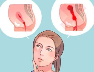 За якими симптомами визначити викидень або місячні? цикл