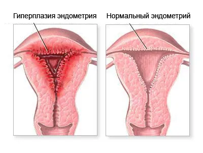 місячні коричневого кольору зі згустками