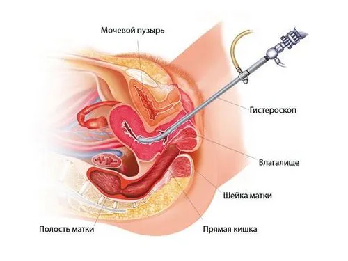 коли починаються місячні після чищення