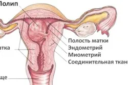 хвороби матки