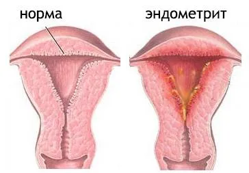 коричневі виділення після місячних