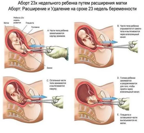 якомога перервати вагітність