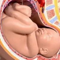 35 тиждень вагітності сідничне передлежання