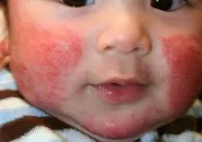холодова алергія