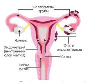 Вплив ендометріозу на плановану або виношувану вагітність ймовірність вагітності при ендометріозі