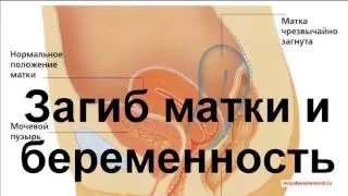як швидко завагітніти при загині матки