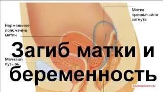 як швидко завагітніти при загині матки