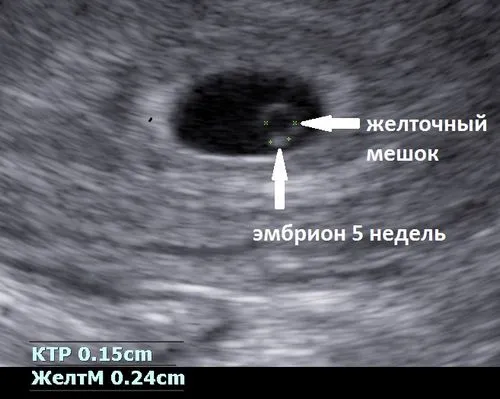 6 тиждень вагітності розмір плода